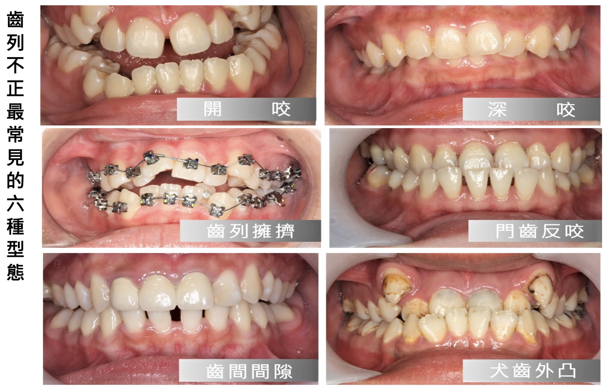 齒顎矯正 | 道明牙醫/安民牙醫/澄正牙醫-牙醫聯盟體系