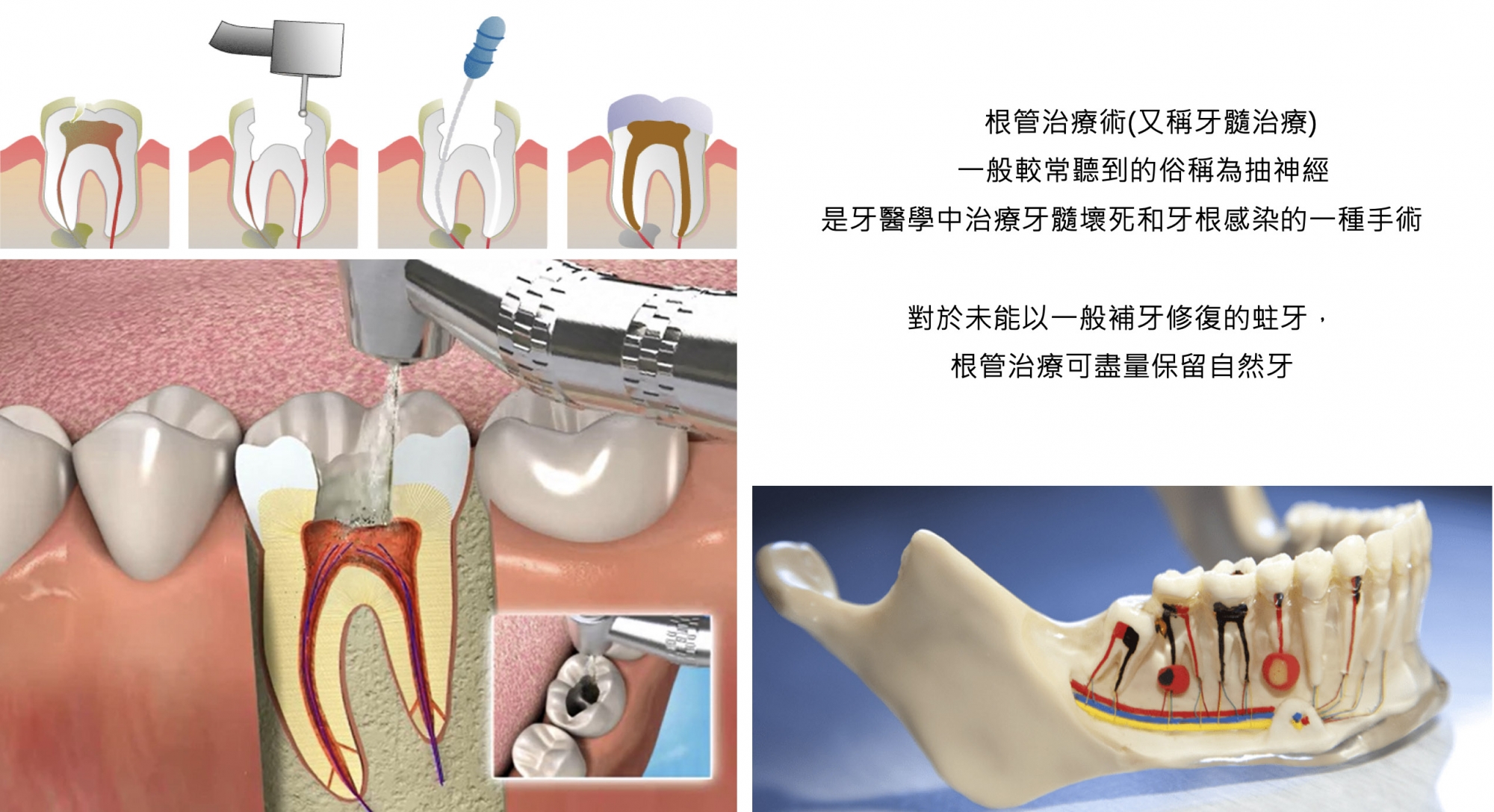 做完根管治疗后如何护理_深圳爱康健口腔医院(官网)