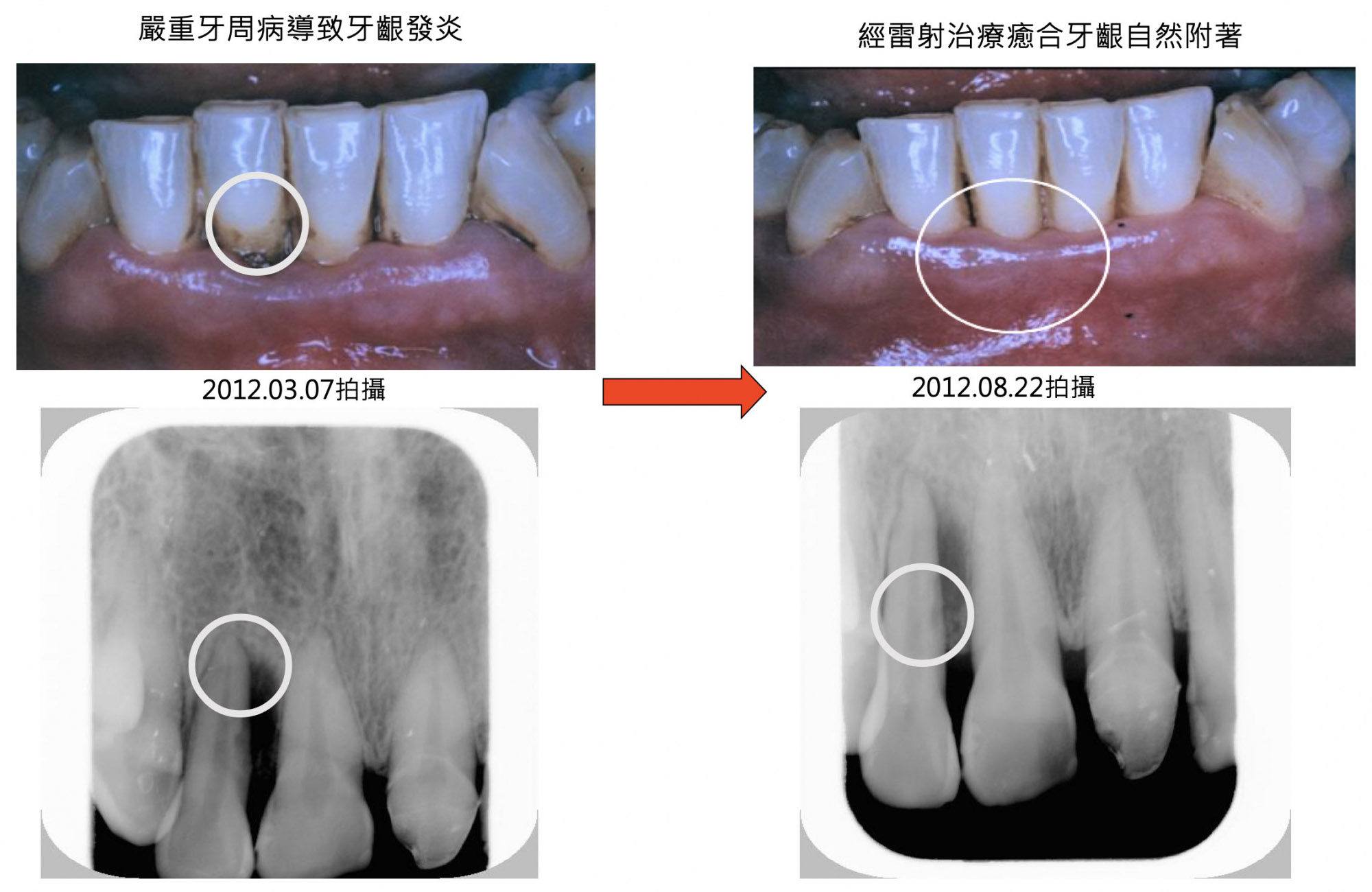 牙周治療實例 | 道明牙醫/安民牙醫/澄正牙醫-牙醫聯盟體系